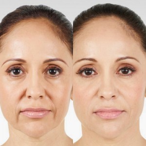 Book a free Consultation for fillers now 1 Juvederm
