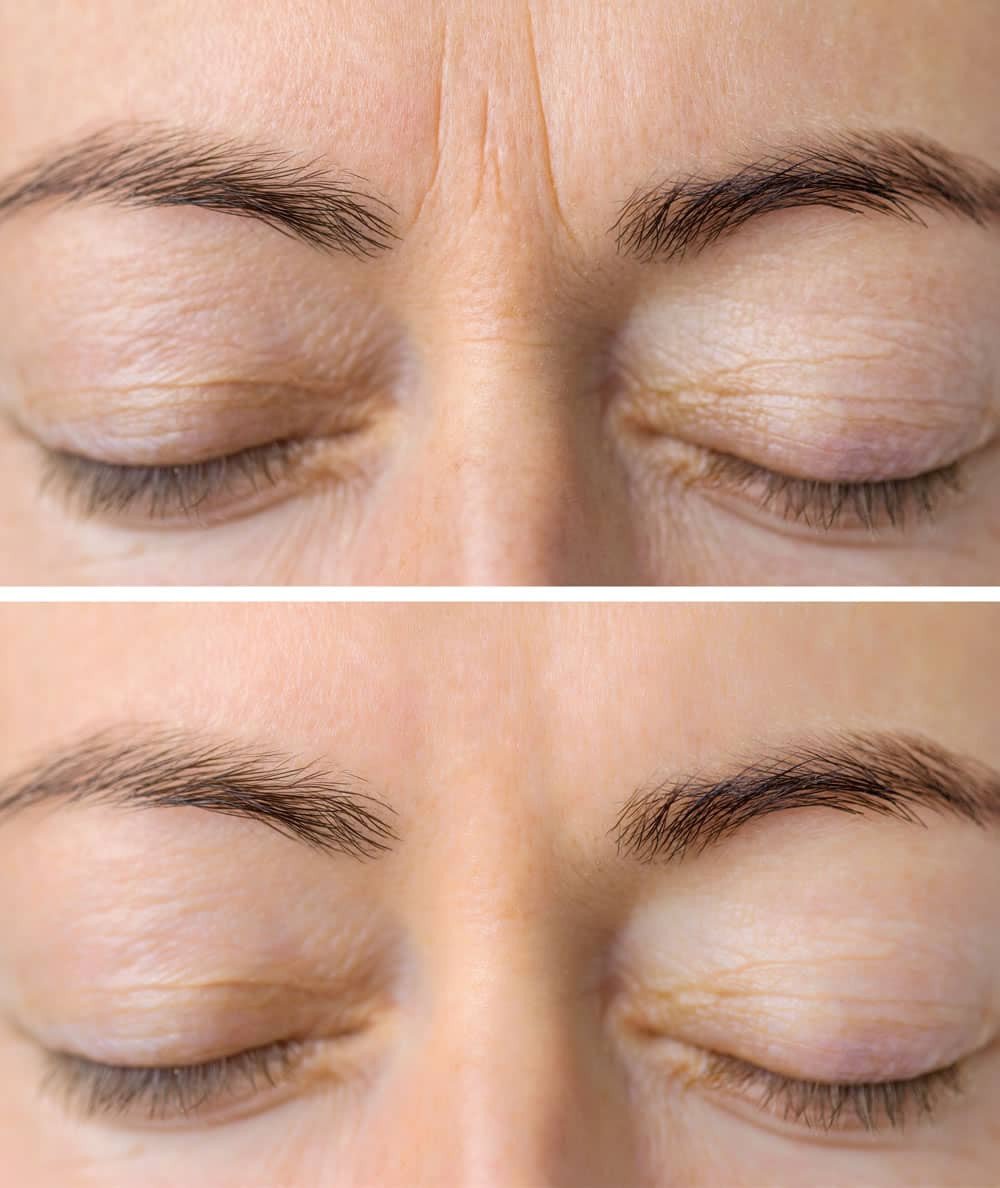 botox-before-and-after Botox Before And After