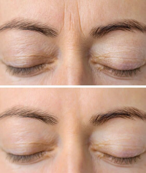 Botox Treatments before and after person is closing eyes with black eyebrows showing the before after results