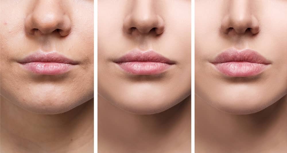 Dermal Fillers are shown to enhance lip fullness, as the sequence of images progresses from natural lips on the left to subtly augmented lips in the center, and more pronounced fullness on the right.