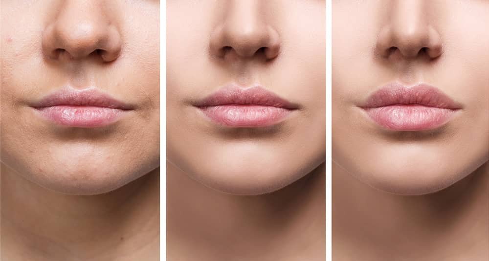 Dermal Filler Lips Dermal Fillers are shown to enhance lip fullness, as the sequence of images progresses from natural lips on the left to subtly augmented lips in the center, and more pronounced fullness on the right.