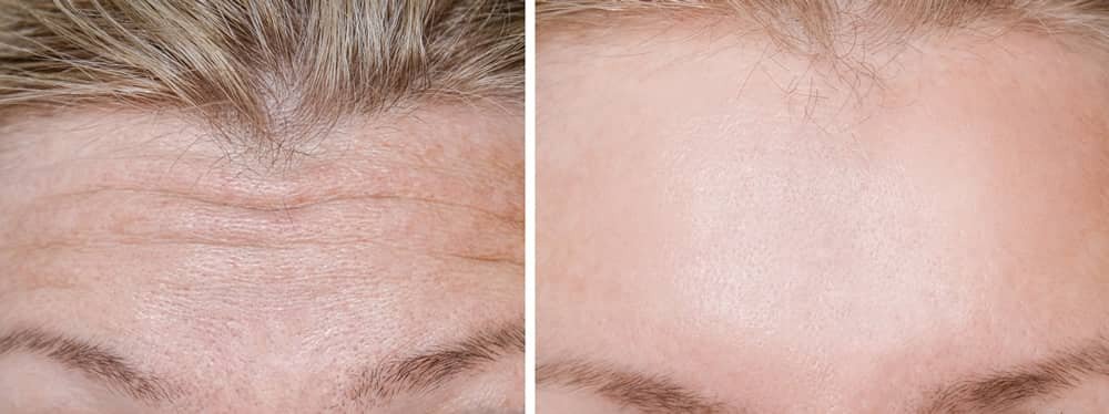Dermal Fillers can visibly reduce forehead lines, as evidenced by the smoother appearance in the after photo compared to the pre-treatment image.