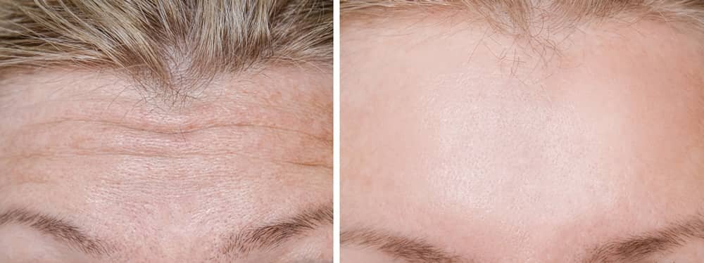 Dermal Fillers Forehead Before and After Dermal Fillers can visibly reduce forehead lines, as evidenced by the smoother appearance in the after photo compared to the pre-treatment image.