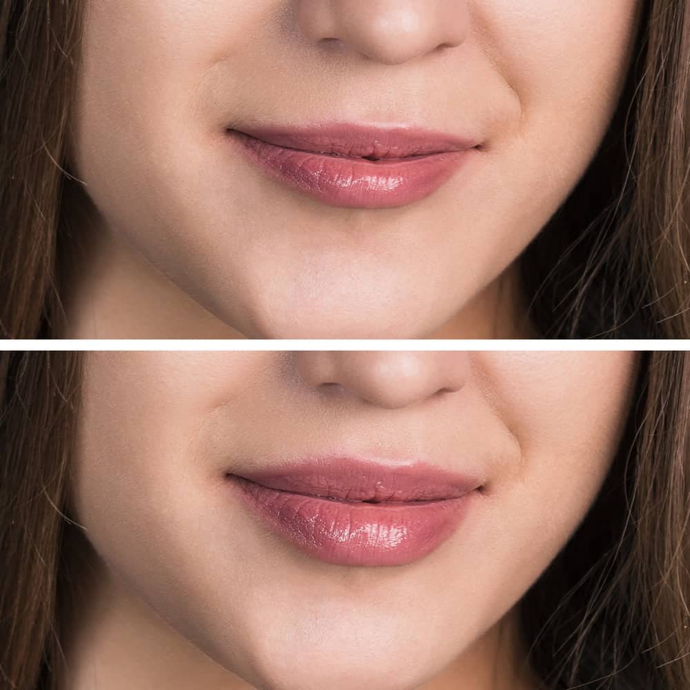 Lip Fillers Before and After Lip Fillers have subtly enhanced the volume and definition of the lips in the bottom image compared to the top, showcasing a natural augmentation.