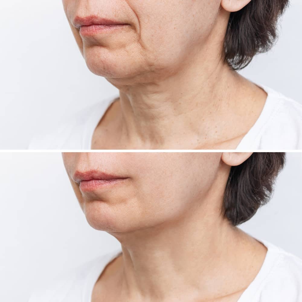 Sculptra Before and After Sculptra treatments have visibly reduced the appearance of neck lines and wrinkles in the after photo, presenting a smoother and more youthful neck profile compared to the before photo